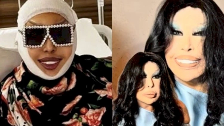 Bülent Ersoy estetik əməliyyatdan sonra