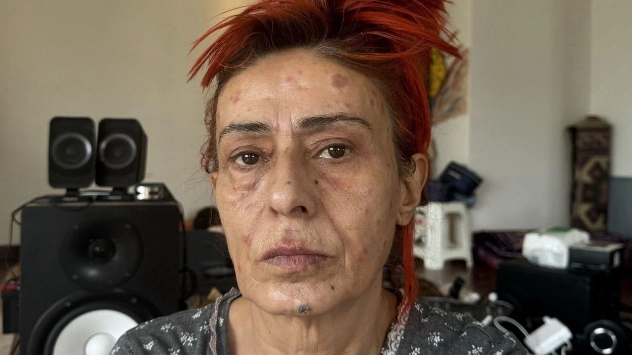 Xəstəxanaya yerləşdirilən Yıldız Tilbedən AÇIQLAMA