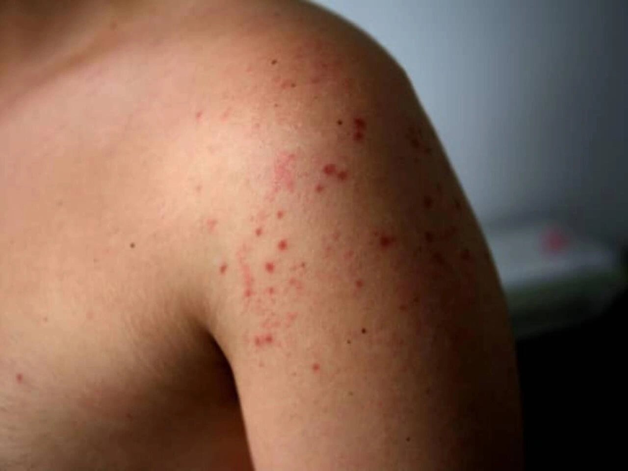 Bu virus dəmir dövründən bəri var imiş